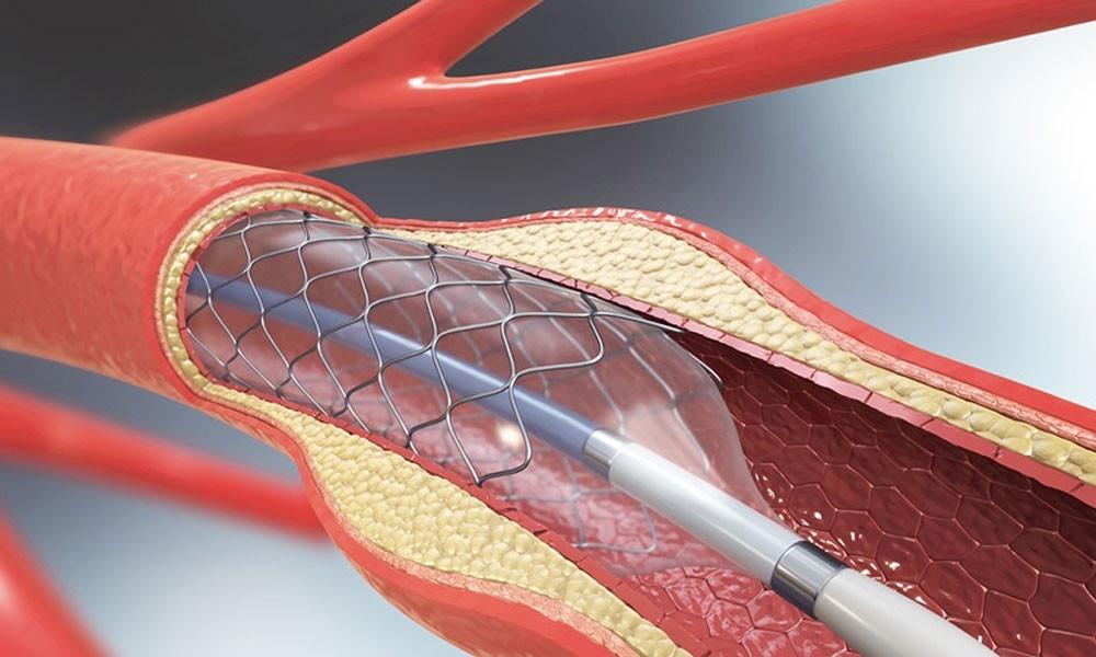 Стент видео. Стентирование сосудов сердца. Лазерная ангиопластика коронарных артерий.